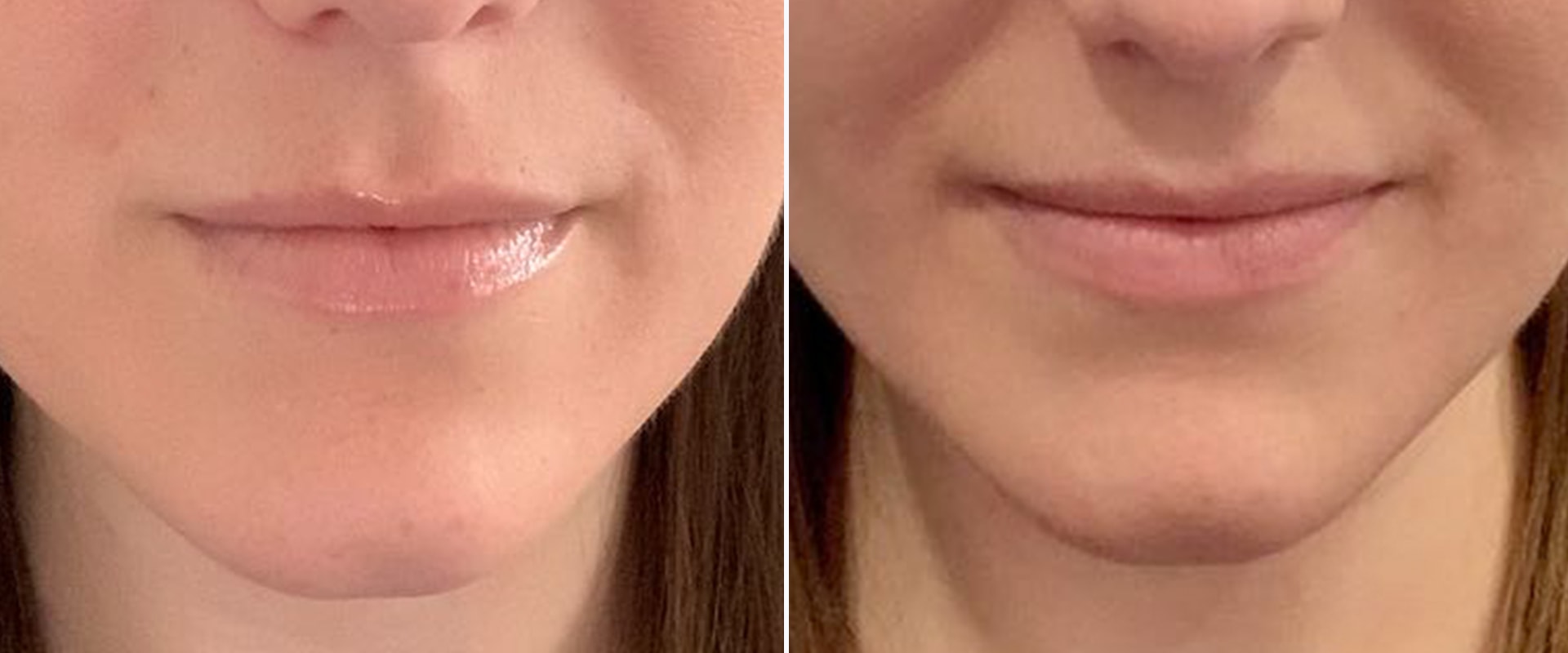 Which Juvederm is Best for Nasolabial Folds?