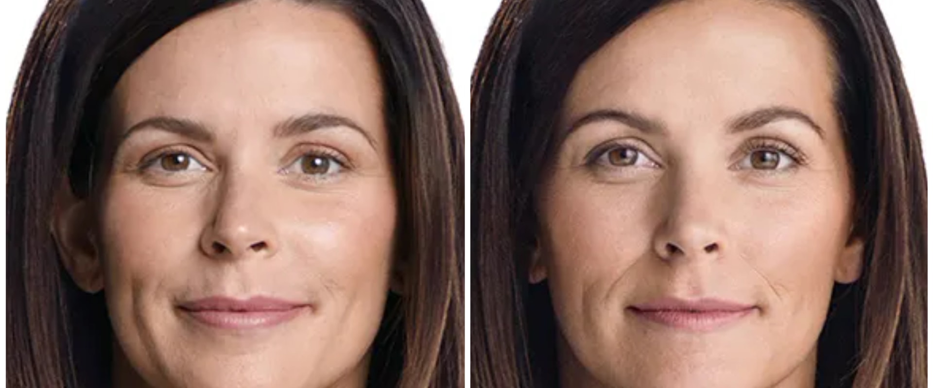 How Long Does Juvederm Last?