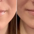 Which Juvederm is Best for Nasolabial Folds?