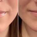 What juvederm is best for nasolabial folds?