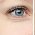 Can Juvederm and Botox Be Used Together?