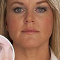 The Dangers of Dermal Fillers: What You Need to Know