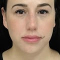 Which Juvederm is Best for You?