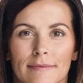 Can Juvederm Ultra Be Used to Treat Nasolabial Folds?