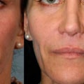 How much is juvederm in nyc?