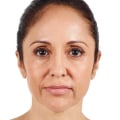 Which Filler is Better: Restylane or Juvederm?