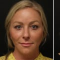 Where to Find the Best Juvederm Near Me