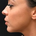 How Much Does a Bottle of Juvederm Cost?