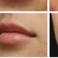 Can You Massage Juvederm Away Safely?