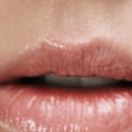 Can Juvederm Cause Blindness? - A Comprehensive Guide