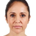 What is Juvederm and What is it Made Of?