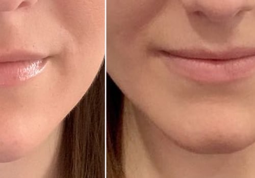 Which Juvederm is Best for Nasolabial Folds?