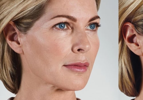 Juvederm: A Comprehensive Guide to Where it Can Be Used