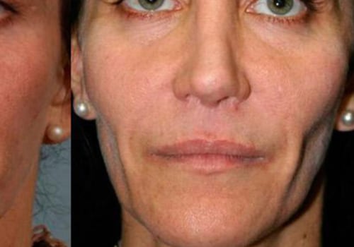 How Much Does Juvederm Cost in NYC?