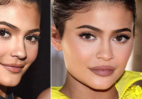 Can Juvederm Filler Be Dissolved?
