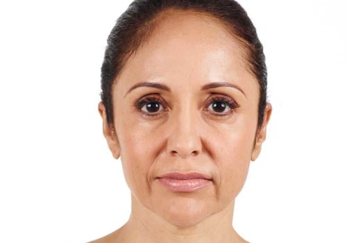 Which Filler is Better: Restylane or Juvederm?
