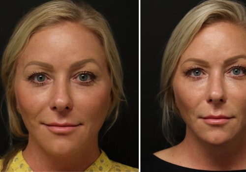 Where to Find the Best Juvederm Near Me