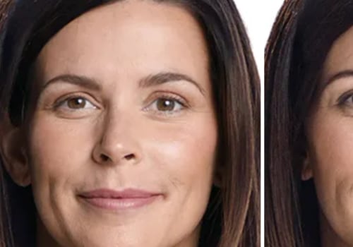 How Long Does Juvederm Last?