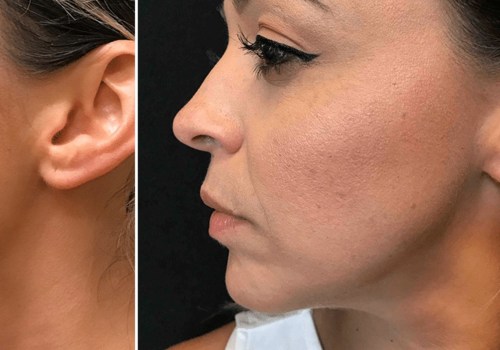 How Much Does a Bottle of Juvederm Cost?