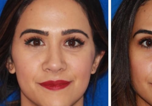 What Fillers are Used to Treat Volume Loss Under the Eyes?