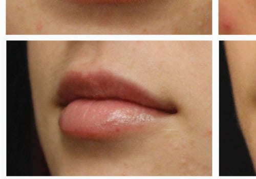 Can You Massage Juvederm Away Safely?