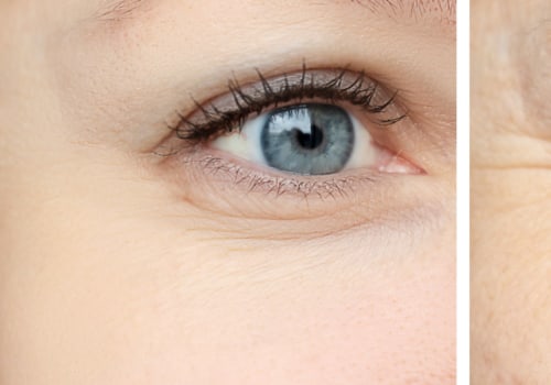 What's Better: Fillers or Botox?