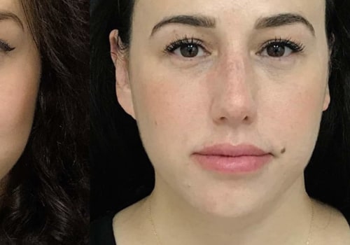 What is Juvederm Best Used For?